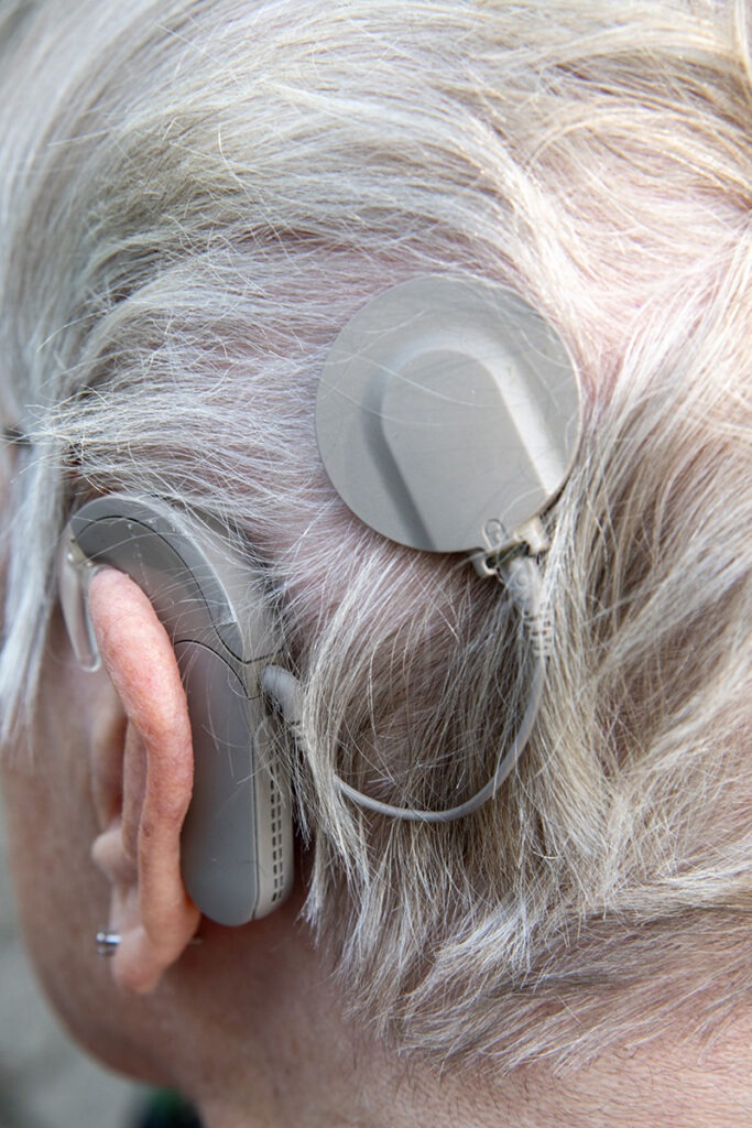 Close-up of the back of a persons head, showing a cochlear implant device attached behind their ear and a circular external transmitter placed on their scalp among light gray hair.