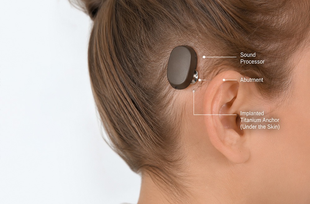 A close-up of a woman’s ear showing a bone-anchored hearing device with labeled parts: sound processor, abutment, and implanted titanium anchor under the skin.